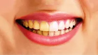 6 thói quen hàng ngày khiến răng ố vàng, xỉn màu