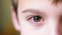 Mắt bị khô và mỏi: Nguyên nhân, biểu hiện và cách khắc phục