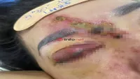 Tiêm filler nâng mũi ở spa, cô gái 27 tuổi bị mù mắt phải, chủ spa phủi trách nhiệm