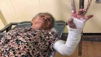 TP.HCM: Cụ bà 86 tuổi gãy cầu vai nhưng được bó bột... nguyên cánh tay